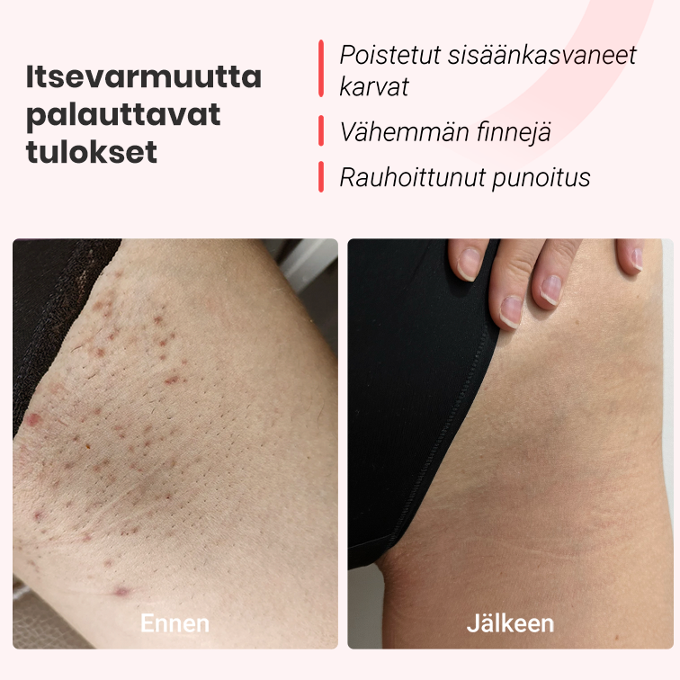 IPL -valoepilaattori